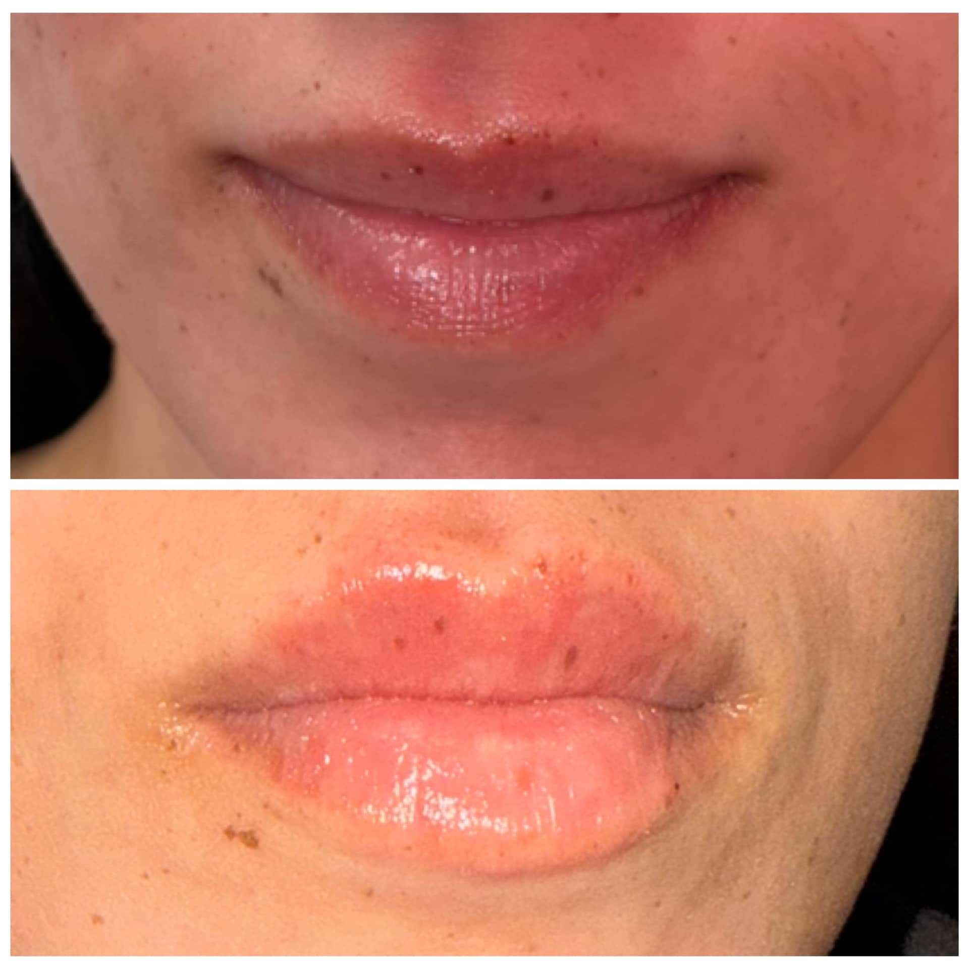 Before and After Image: Lip Filler - front