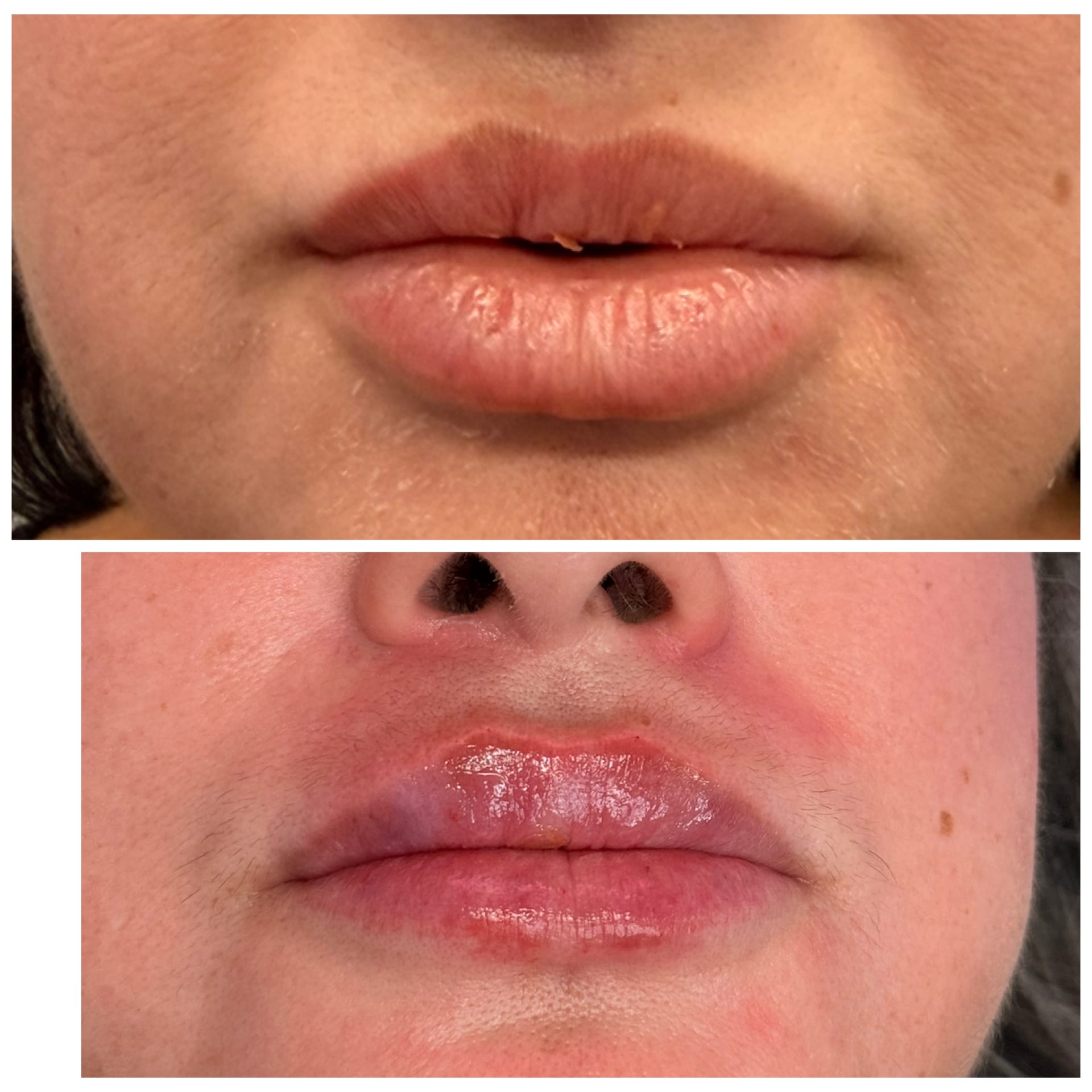 Before and After Image: Lip Filler - front