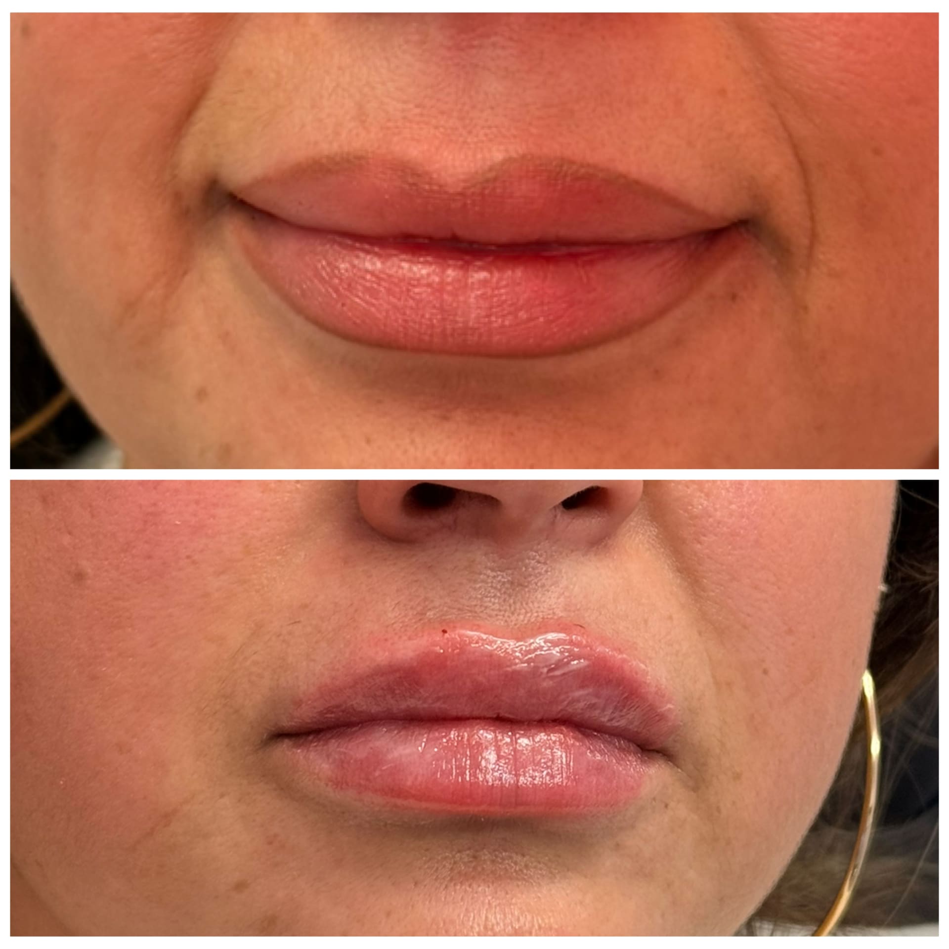 Before and After Image: Lip Filler - front