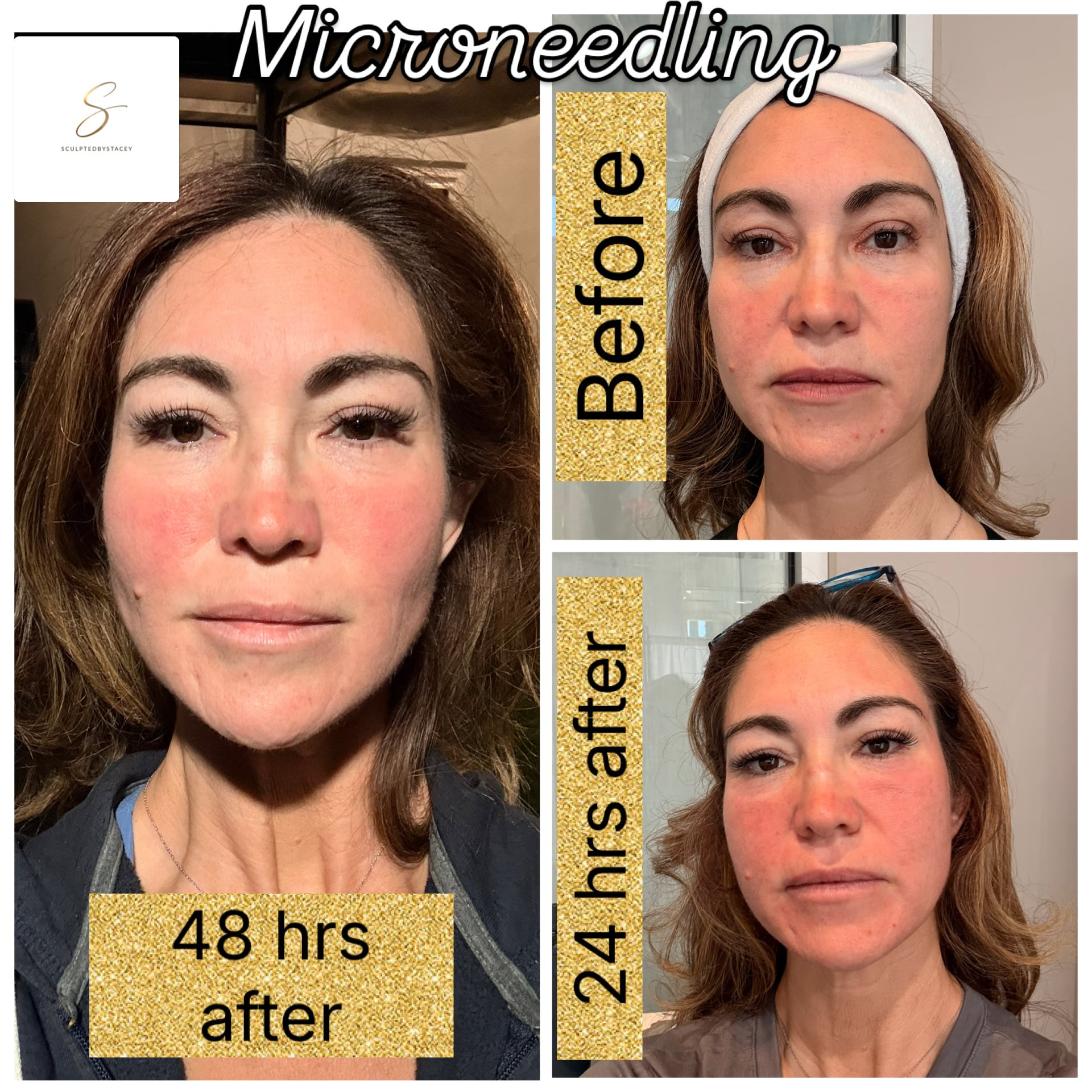 Before and After Image: Microneedling - front