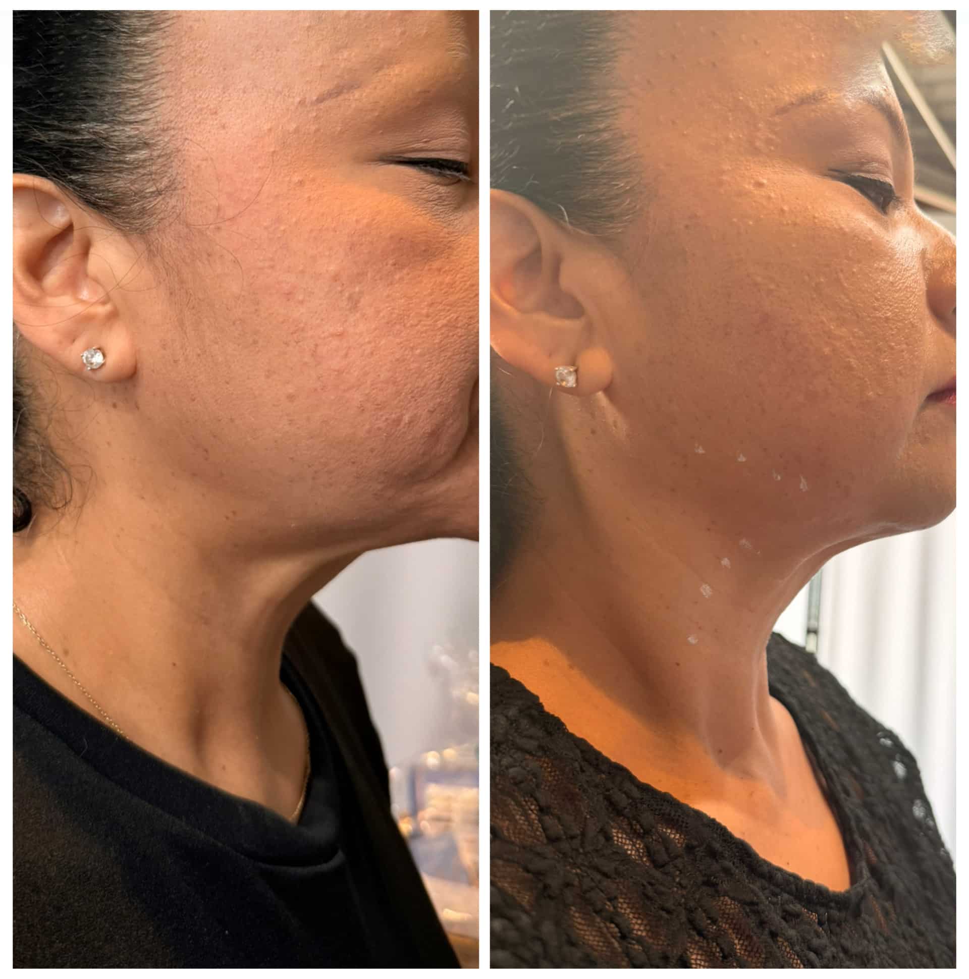 Before and After Image: Nefertiti and Platysmal Band - front