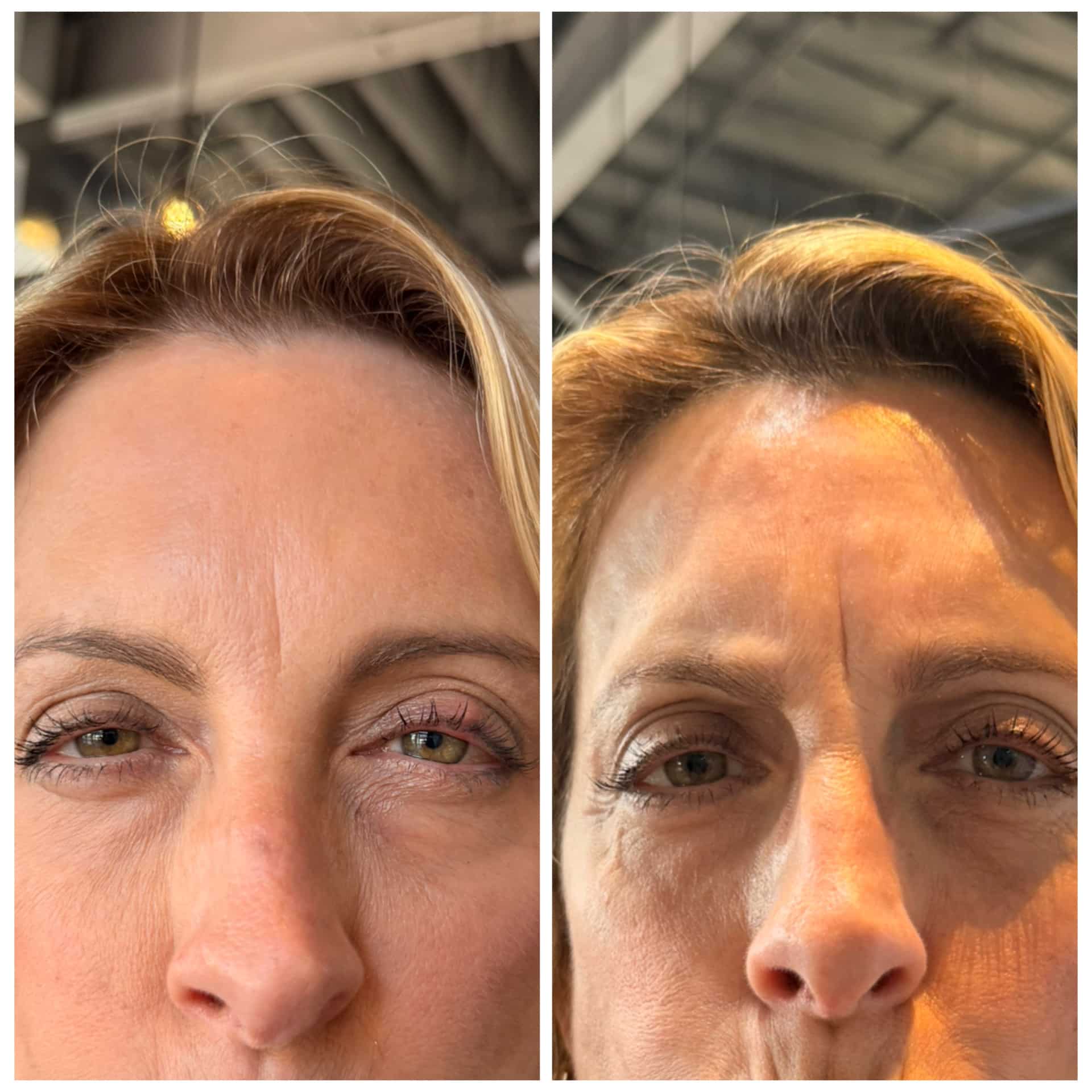 Before and After Image: Wrinkle Relaxers - front