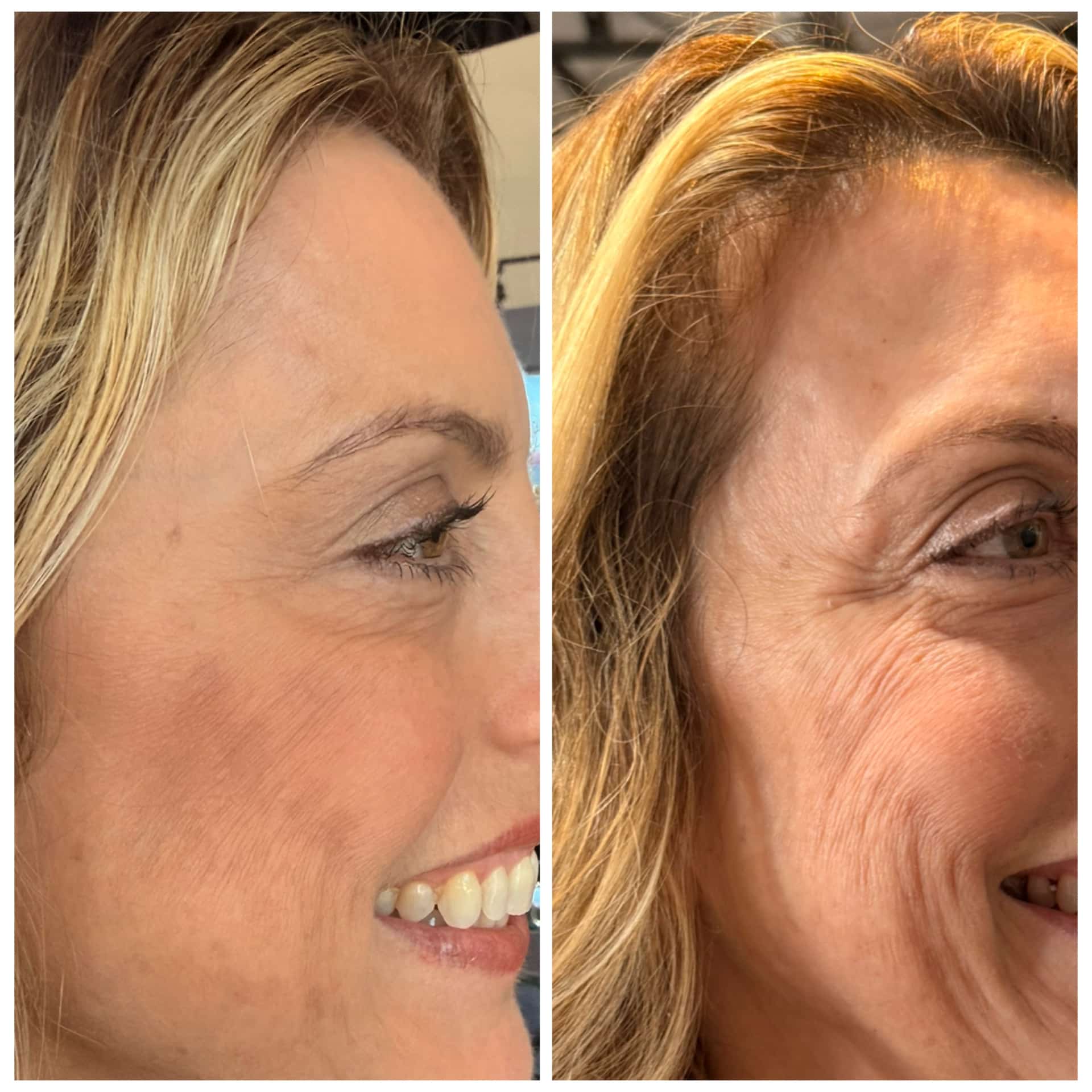 Before and After Image: Wrinkle Relaxers - right-side