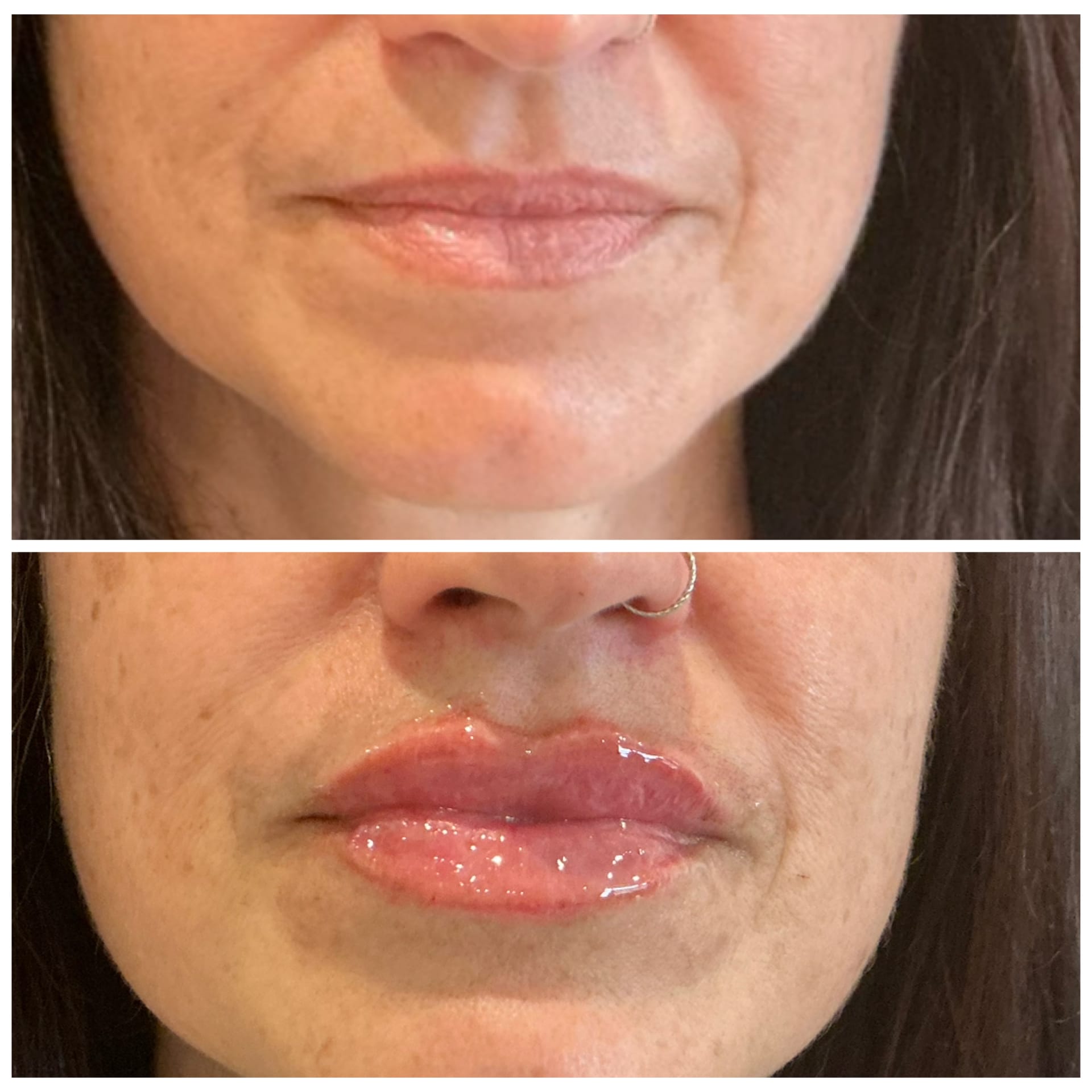 Before and After Image: Lip Filler - front