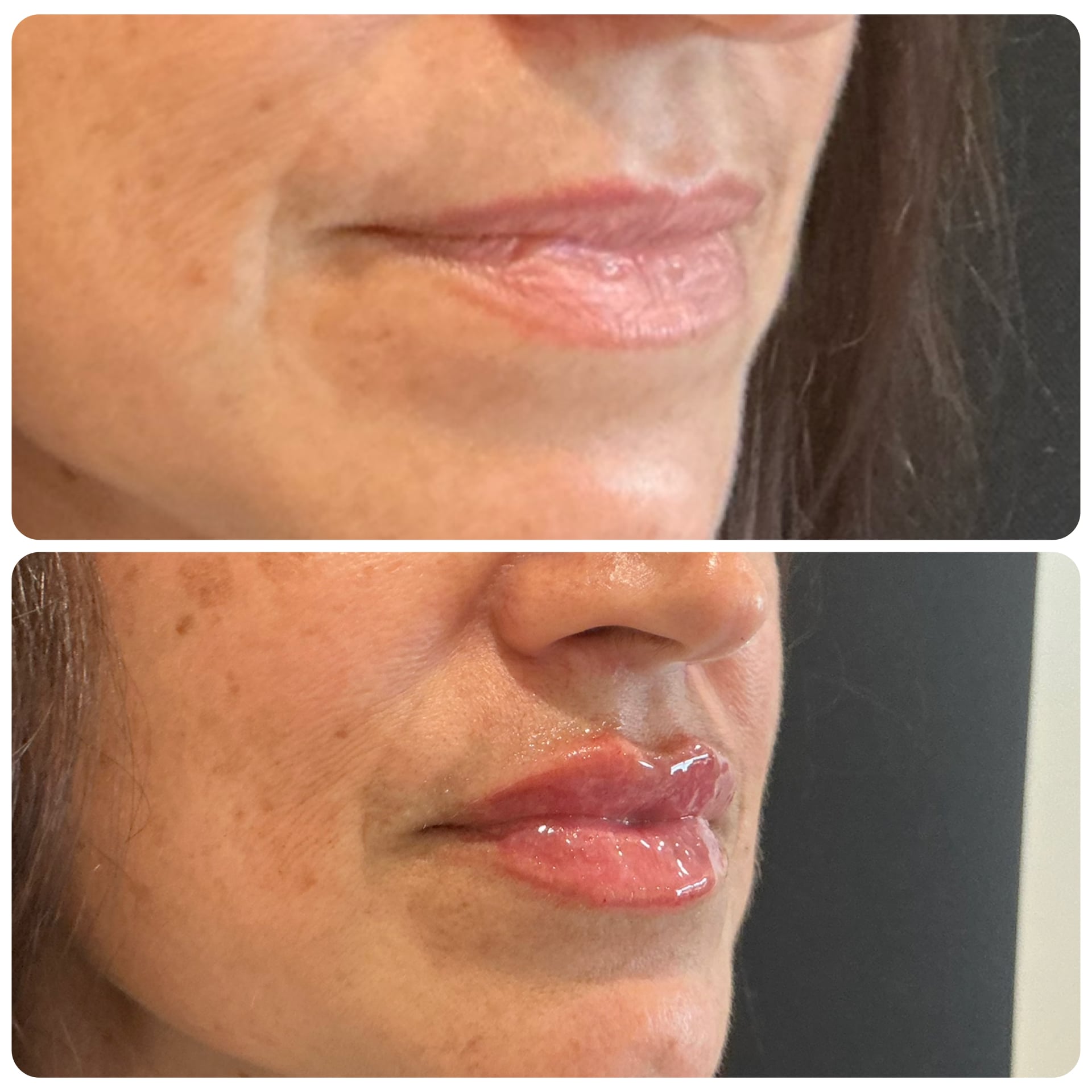 Before and After Image: Lip Filler - right-front-oblique
