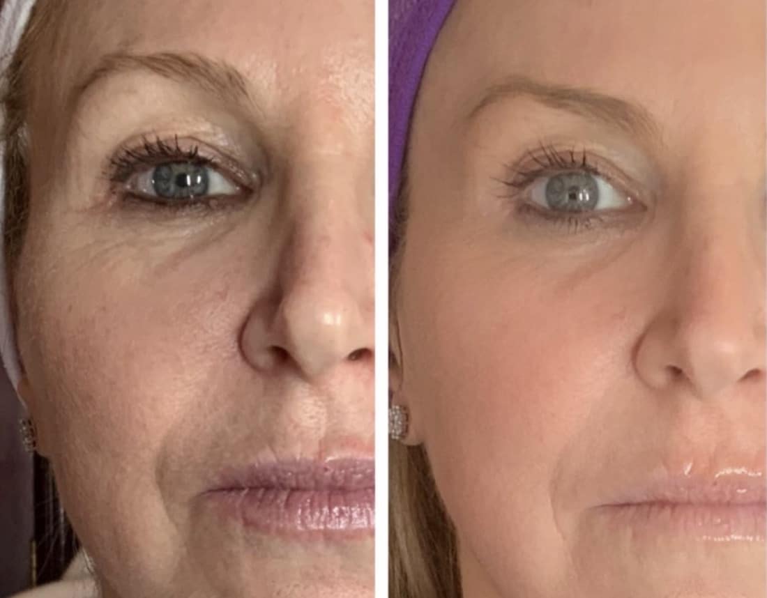 Before and After Image: Neurotoxin - front